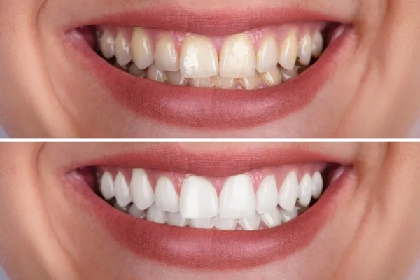 Clareamento dental na Odonto Rir