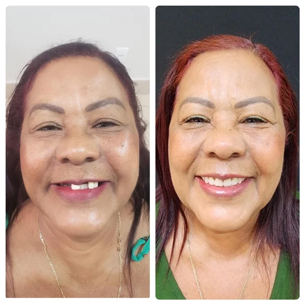 Antes e depois de implante dentário na Odonto Rir