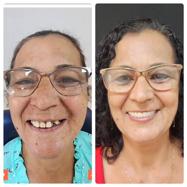Antes e depois de implante dentário na Odonto Rir