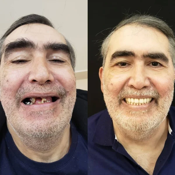 Antes e depois de implante dentário na Odonto Rir