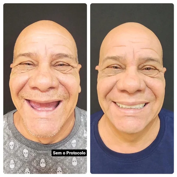 Antes e depois de implante dentário na Odonto Rir