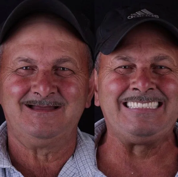 Seu Antônio, antes e depois do implante dentário na Odonto Rir