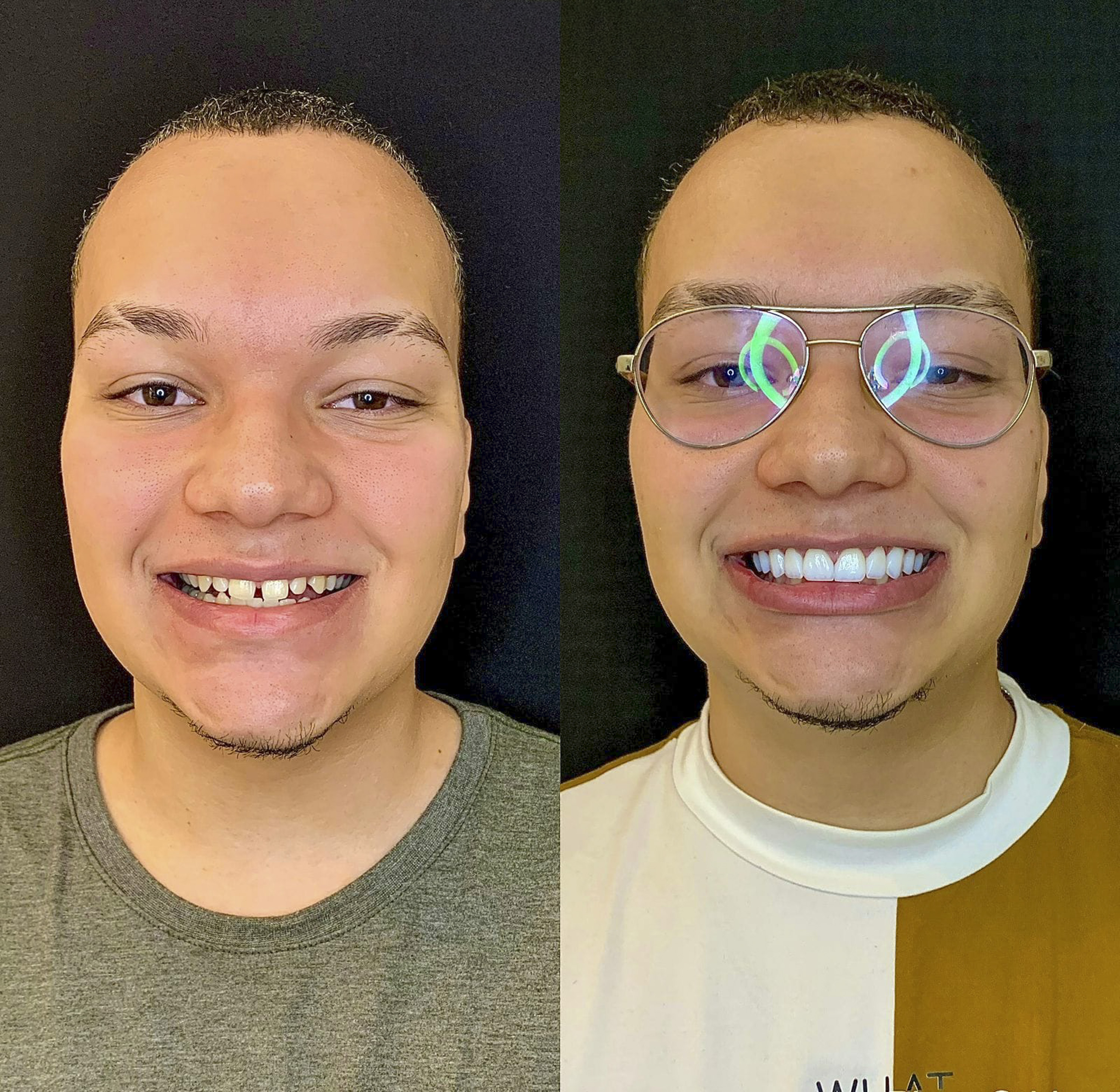 Antes e depois de lentes de contato dental na Odonto Rir