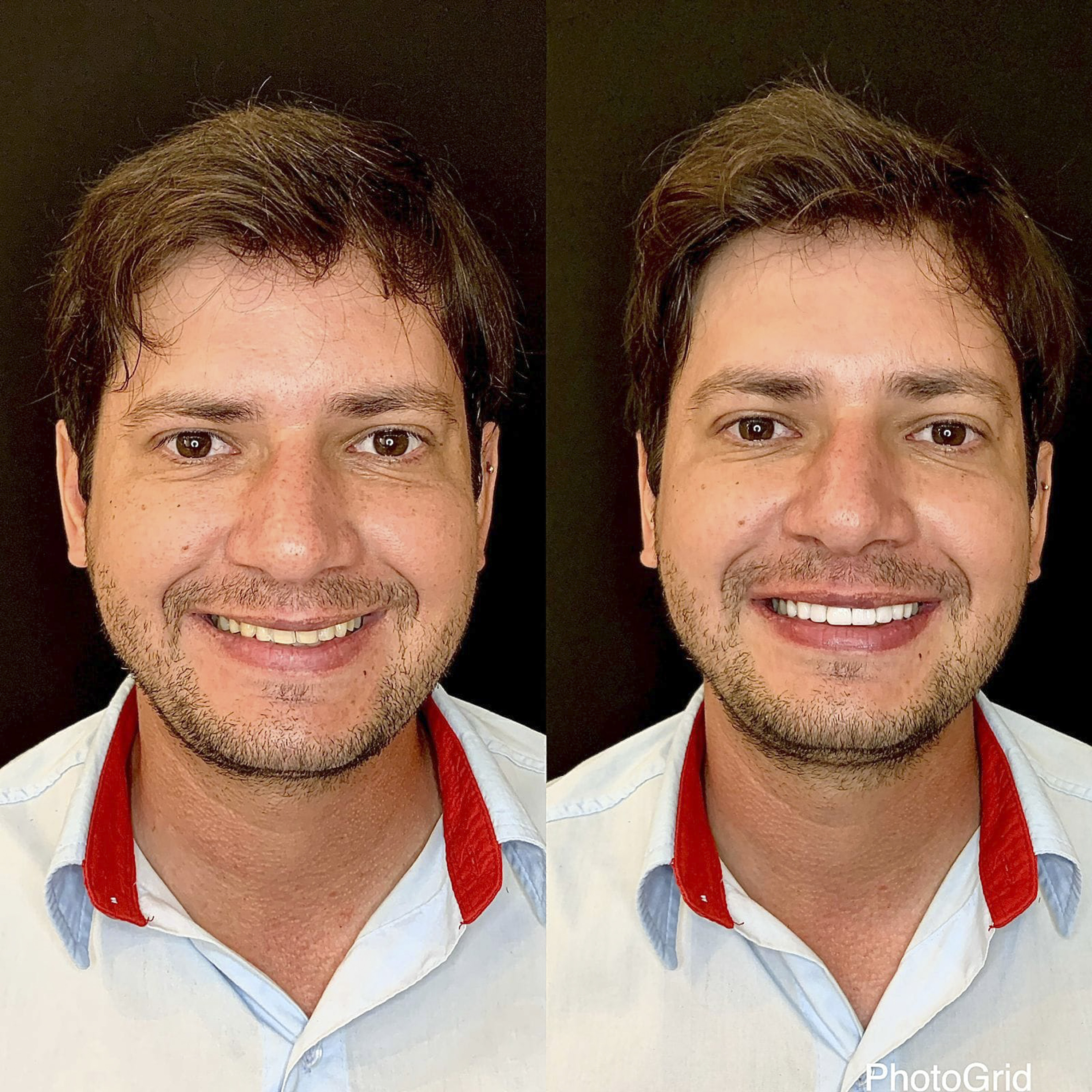 Antes e depois de lentes de contato dental na Odonto Rir