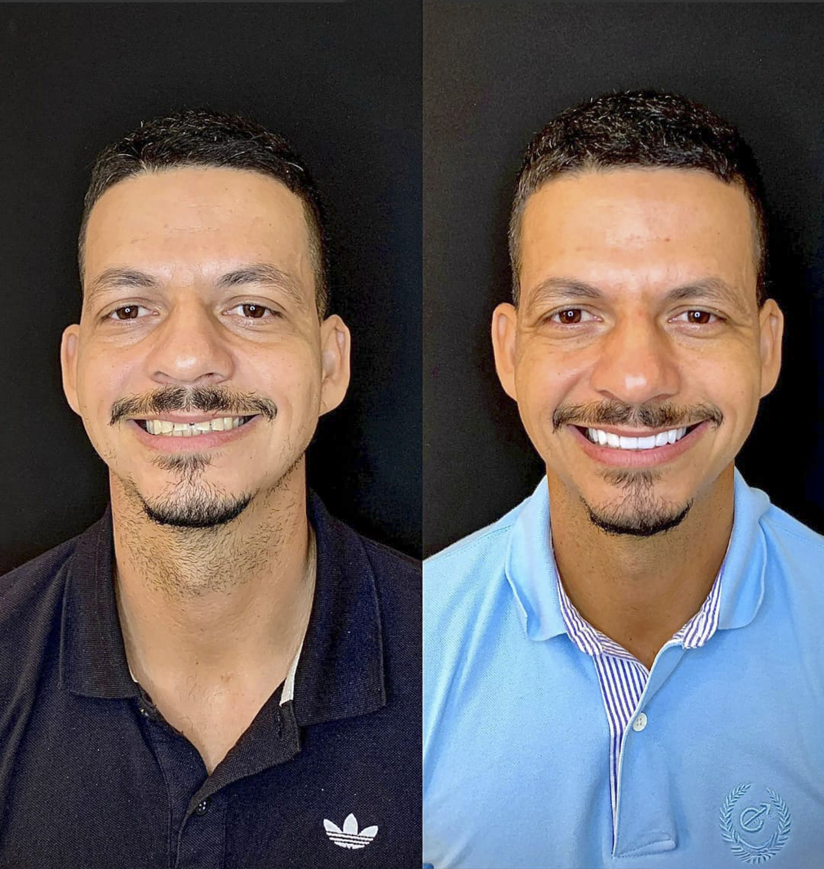 Marcos, antes e depois das lentes de contato dental na Odonto Rir