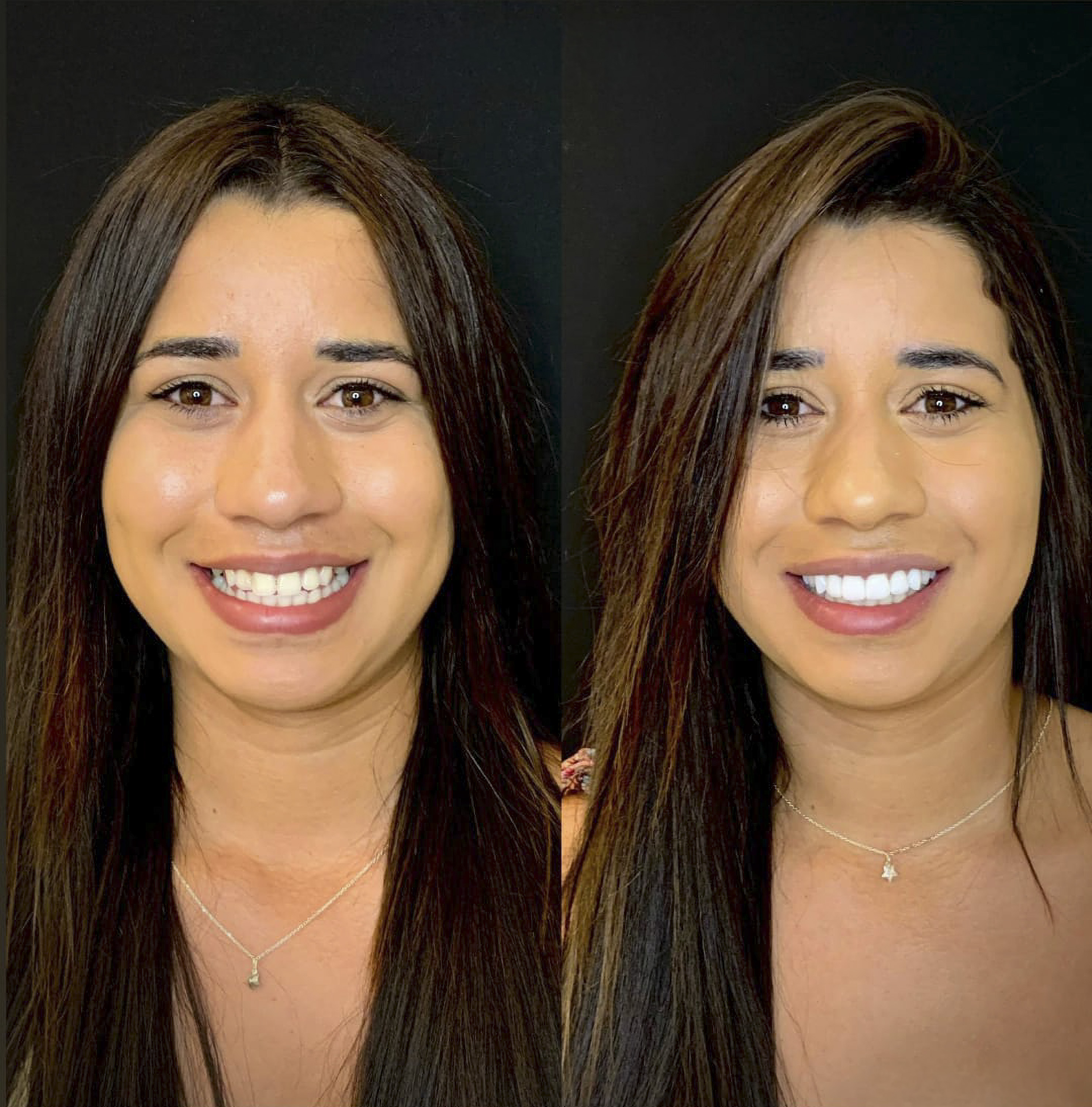 Antes e depois de lentes de contato dental na Odonto Rir