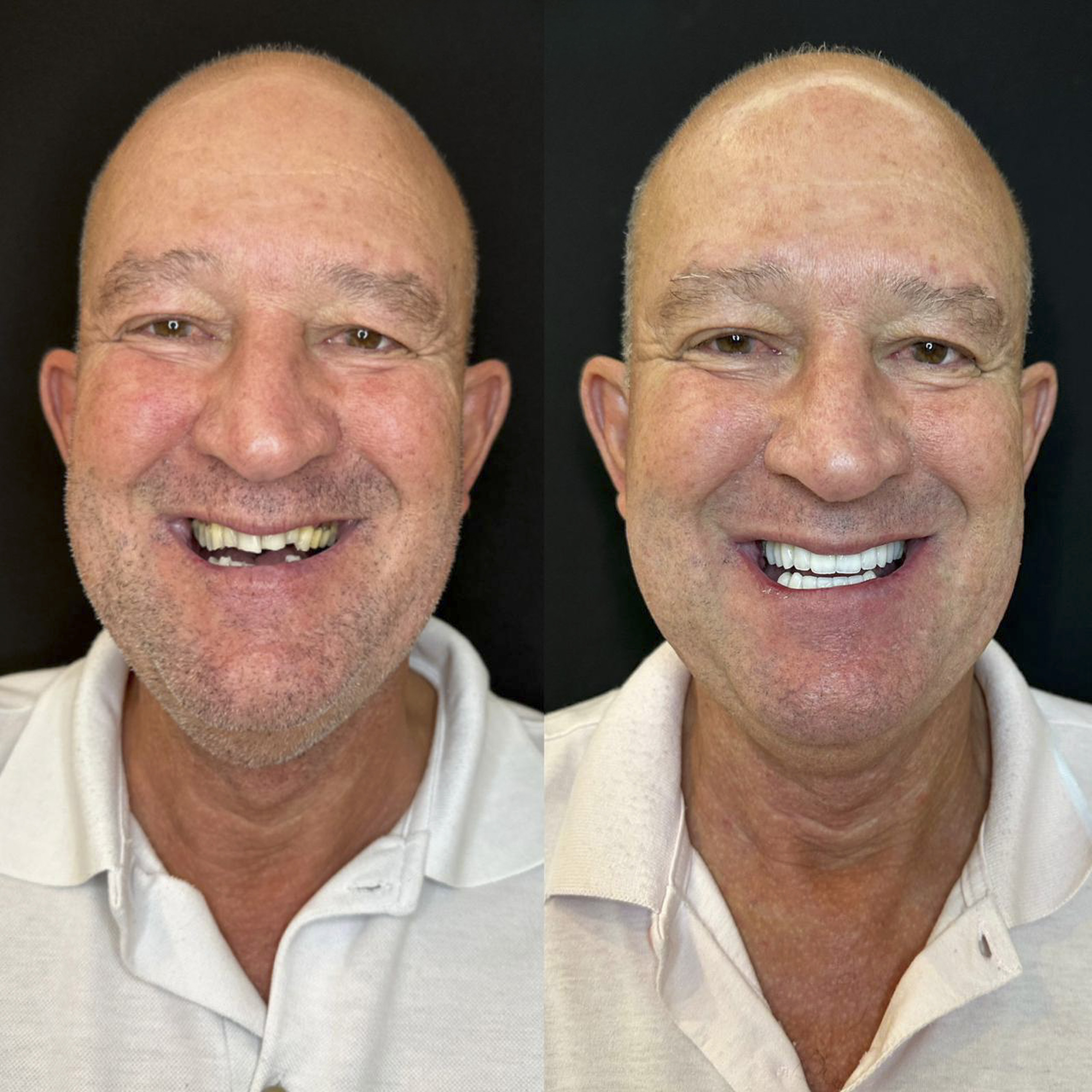 Antes e depois de lentes de contato dental na Odonto Rir
