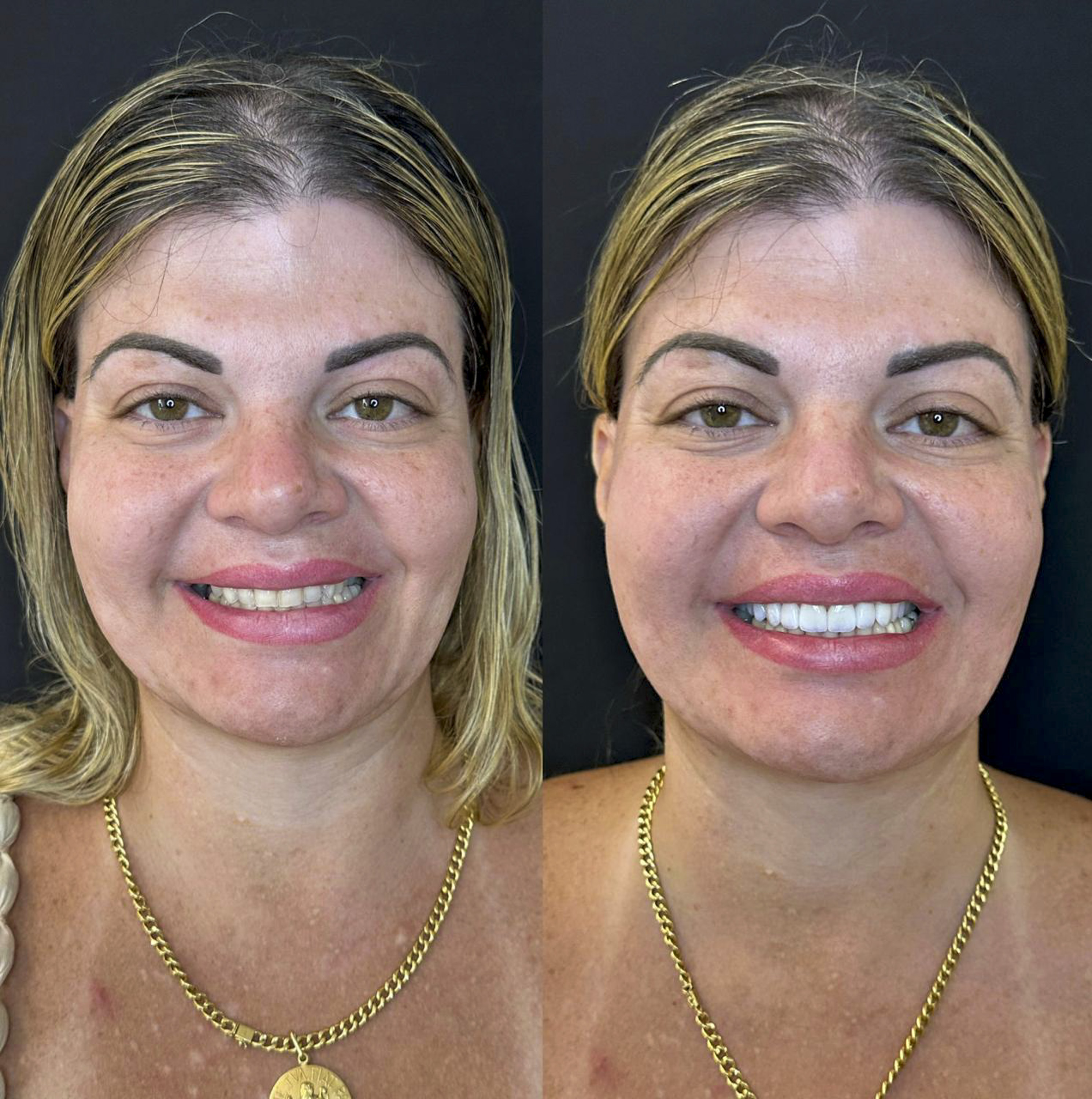 Sandra, antes e depois das lentes de contato dental na Odonto Rir